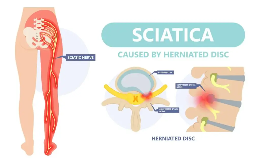 Understanding sciatica