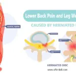 lower-back-pain-and-leg-weakness