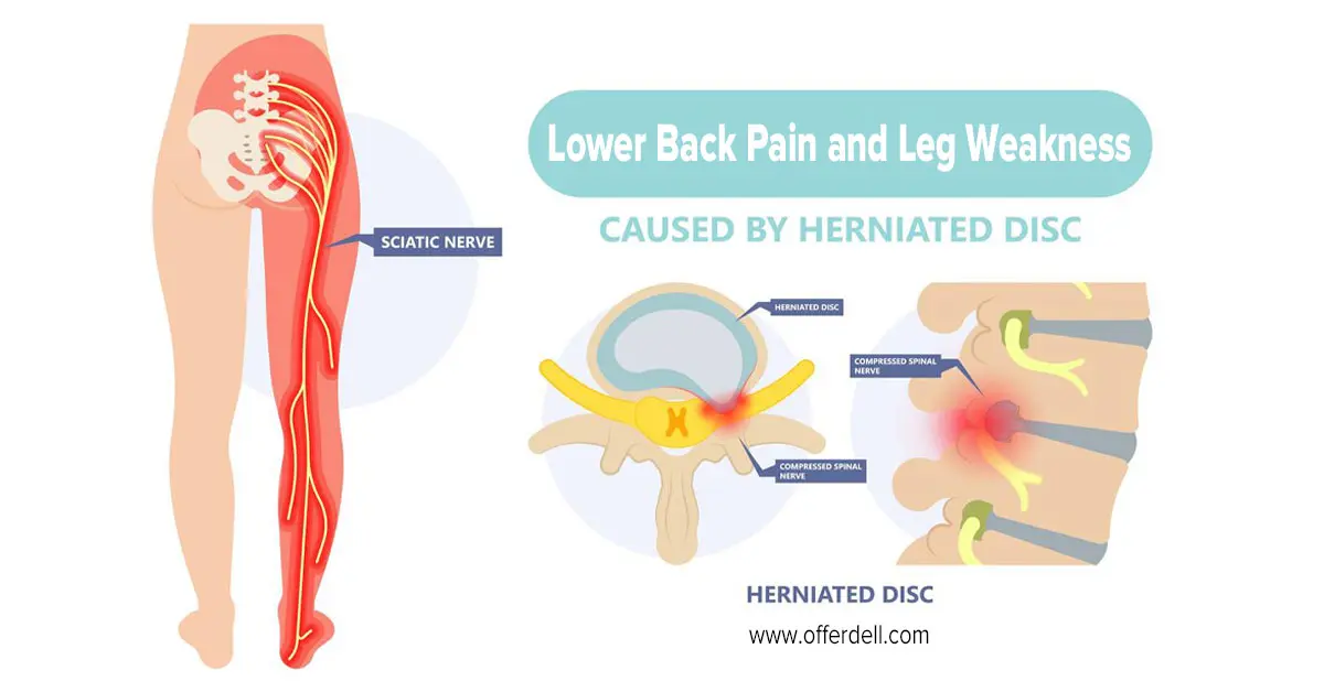 lower-back-pain-and-leg-weakness
